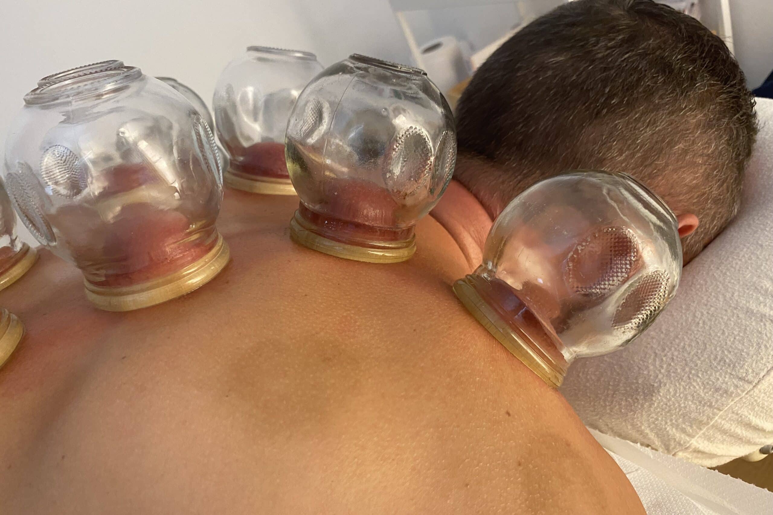 ventouse-nicolas-charlet-cupping-2