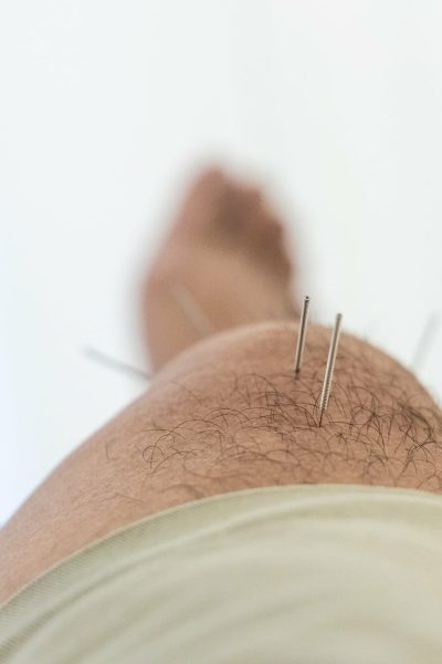 aiguille-acupuncture-energie-geneve-nicolas-charlet-acupuncteur aiguille d'acupuncture sur la jambe d'un patient